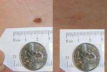 Natural Mole remover  Watch Wart & Skin tag Vanish  
