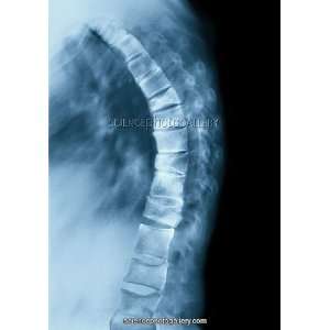  Osteoporosis of the back, X ray Framed Prints