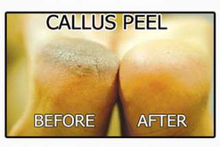 12.5g CRACKED HEEL CREAM   Callus Peel  Hard Skin Removal   RESULTS IN 